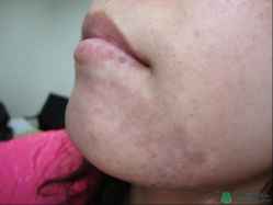 安顺白癜风的治疗费用是多少钱医院